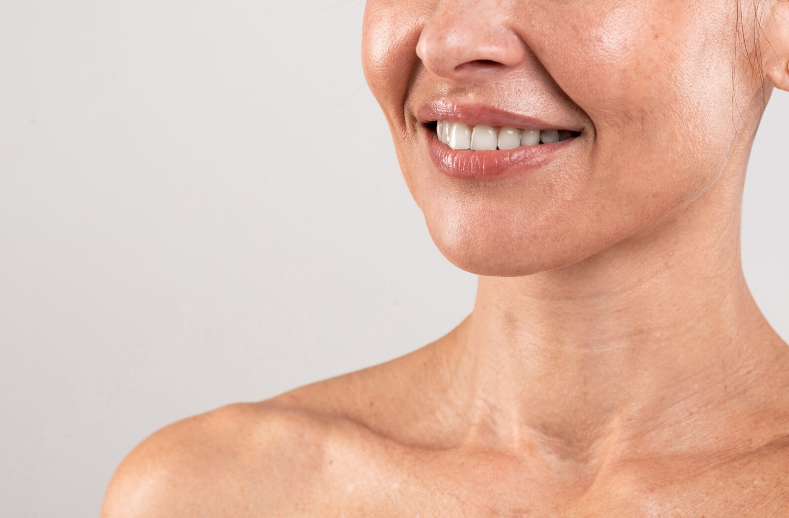 Smile Lines Fillers